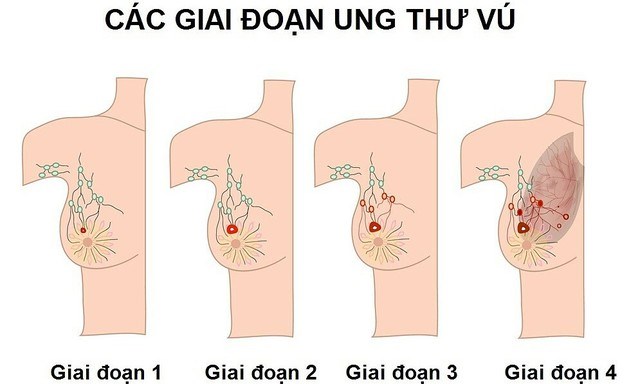 Sơ đồ mô phỏng các giai đoạn tiến triển của ung thư vú