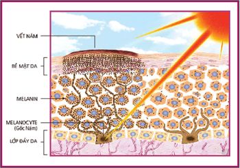 Hình ảnh nám da do ánh nắng mặt trời, sự thật là vì sao?1