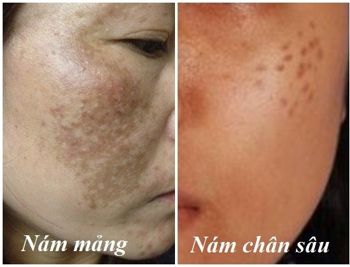 Hình ảnh giúp chị em nhận biết nám nông sâu1