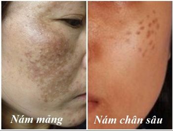 Hiện tại các chuyên gia phân mức độ nám thành hai loại: nám chân sâu và nám nhẹ