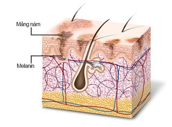 Hình ảnh khám phá melanin và cơ chế hình thành nám da mặt1