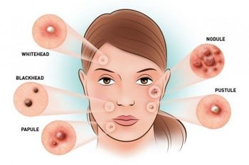 Mất cân bằng nội tiết tố khiến lượng melanin sản sinh quá mức gây nám trên da mặt