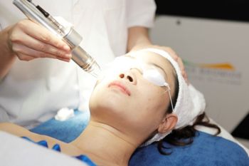 Trị nám bằng laser là cách trực tiếp các tia laser vào hắc tố melanin ở lớp bề mặt da